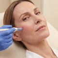 Microneedling